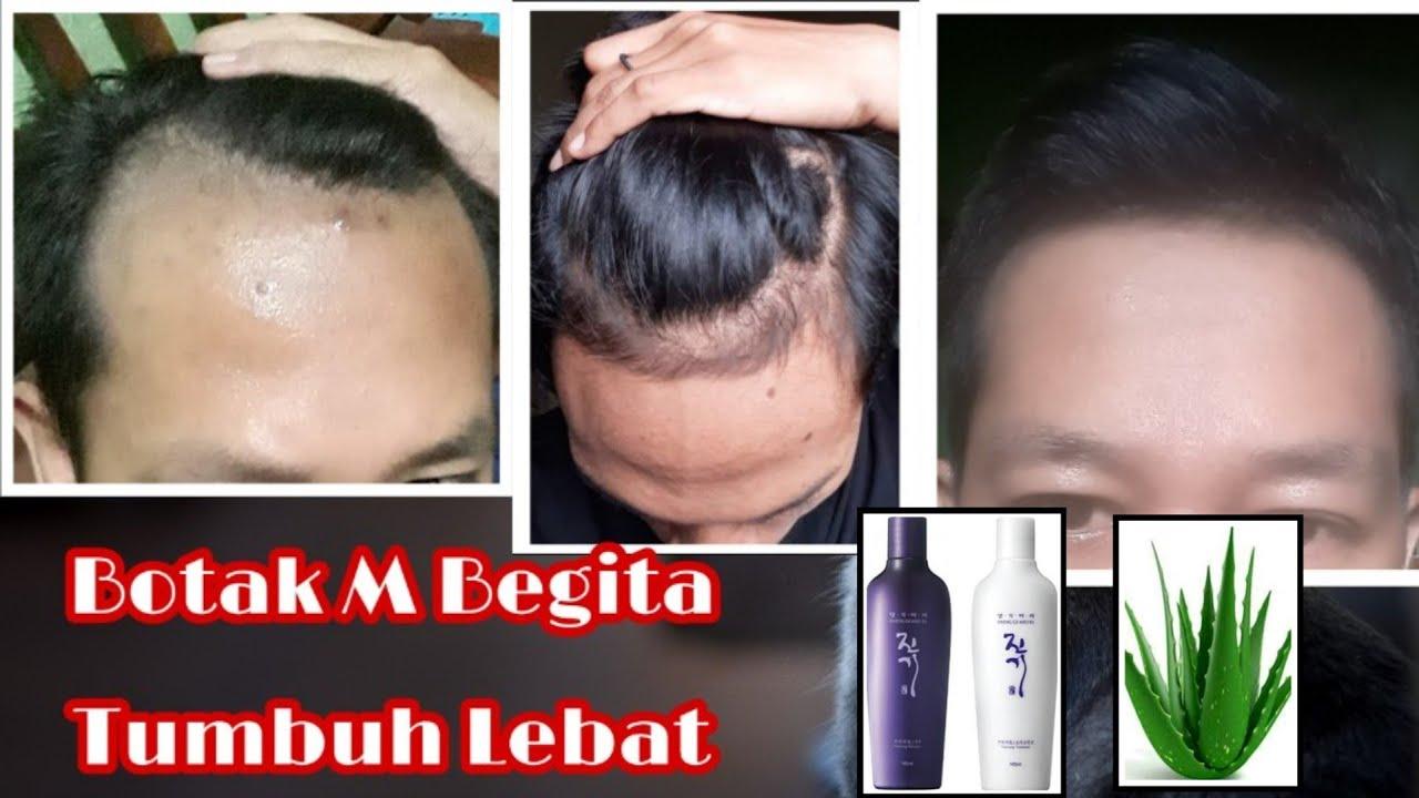 Mengungkap Rahasia Cara Menumbuhkan Rambut Botak dengan Cepat: Tips Ampuh untuk Pertumbuhan Rambut yang Lebih Cepat!