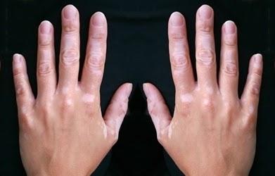 Cara Ampuh Menghilangkan Belang di Wajah Menurut Ahli Kulit: Solusi Efektif untuk Belang di Tangan